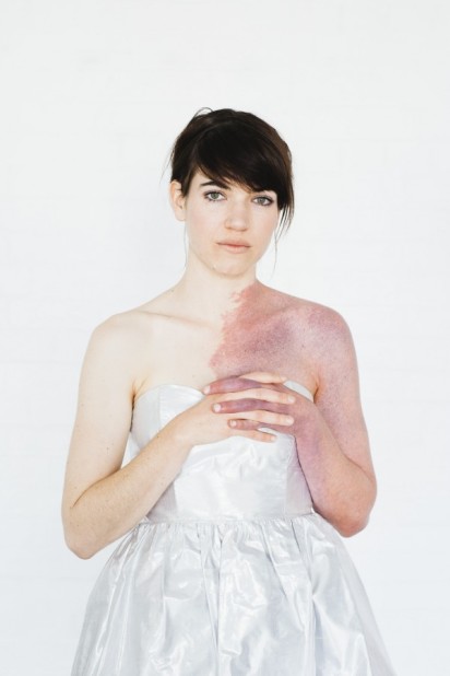 patience hodgson birthmark